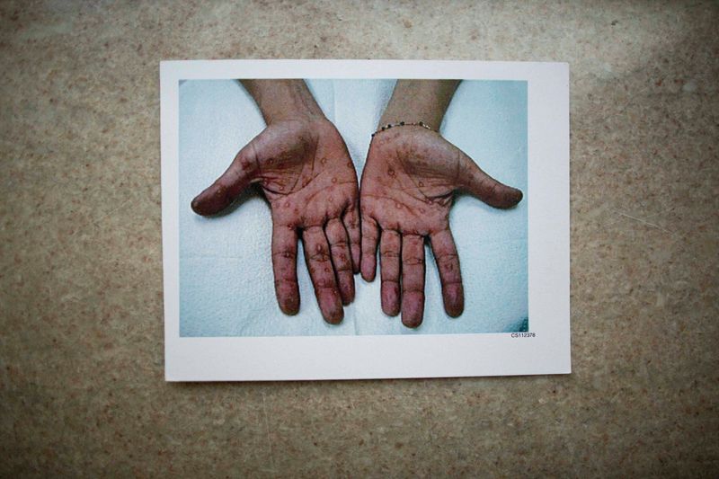 A person's hands are laid flat, palms up, showing many blister-like bumps.